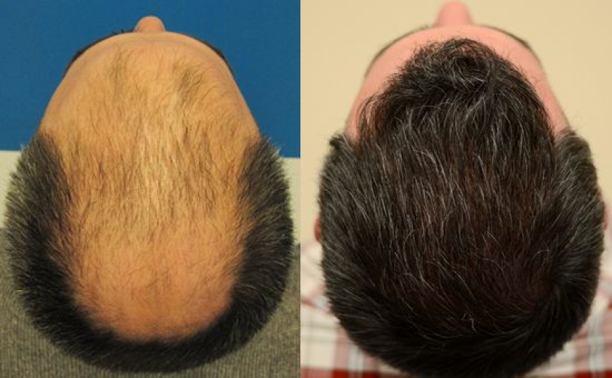 Affordable Hair Transplant Packages in Islamabad: What You Should Know