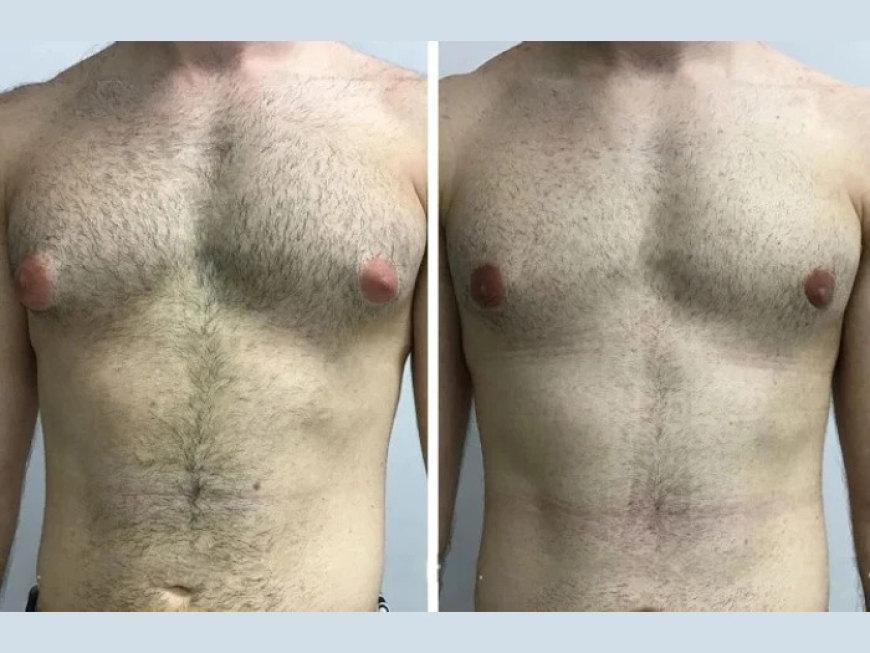 Redefine Your Body with the Best Gynecomastia Surgeon in dubai