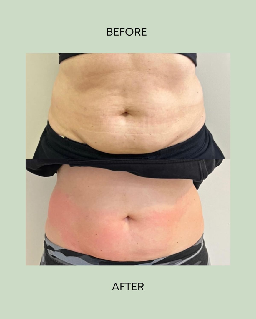 Restore Your Confidence with Tummy Tuck Surgery in Islamabad