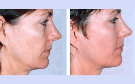 Why Locals Love the Best Aesthetic Clinic in Dubai Fotona 4D Laser