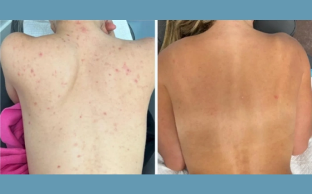 A Safe Choice: Moxi Laser Treatment at the Best Aesthetic Clinic in dubai