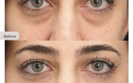 Choosing the Right Under Eye Filler: Tips for Safe and Effective Results
