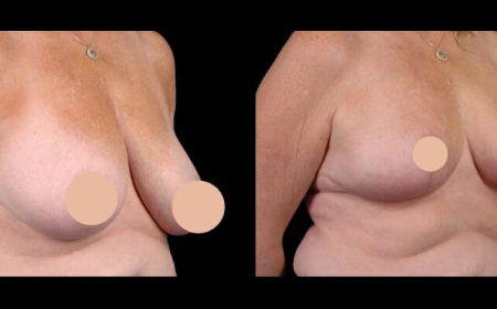 Top Secrets from the Best Doctors in Dubai for Successful Breast Reduction in Dubai