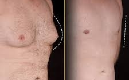 Understanding the Procedure for Gynecomastia in Dubai