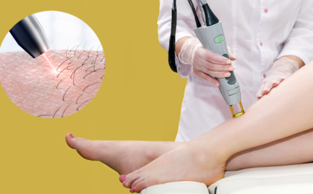 Comprehensive Analysis of the Global Laser Hair Removal Market: Size, Trends, and Strategic Insights