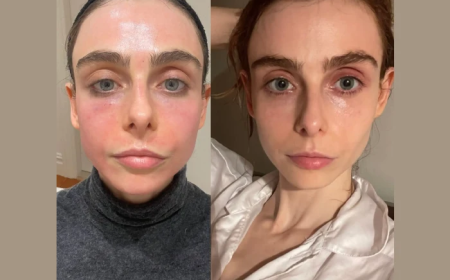 Reverse Aging Signs with Radiofrequency (RF) Microneedling by the Best Plastic Surgeons in dubai