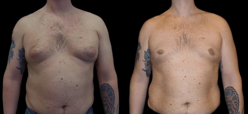 Gynecomastia Surgery in Dubai: Safe, Affordable, and Effective
