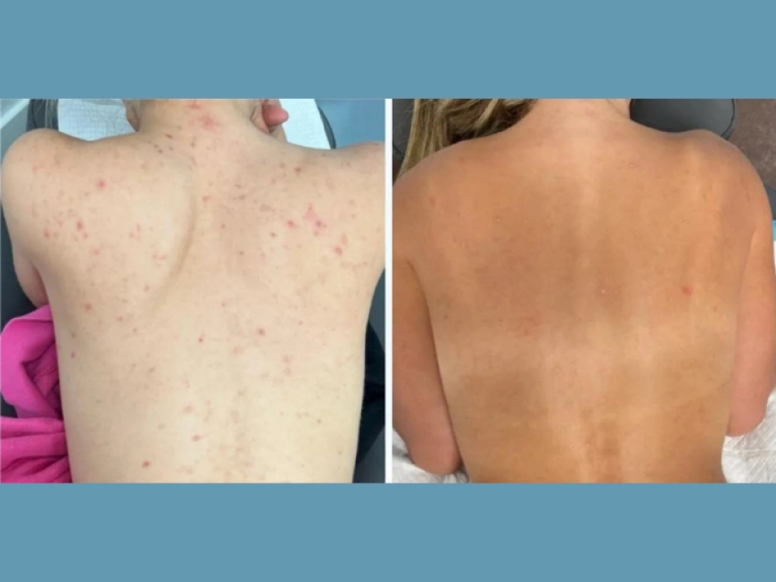 A Safe Choice: Moxi Laser Treatment at the Best Aesthetic Clinic in dubai