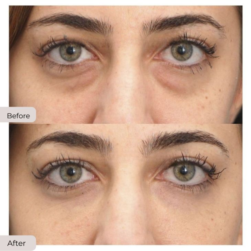 Choosing the Right Under Eye Filler: Tips for Safe and Effective Results