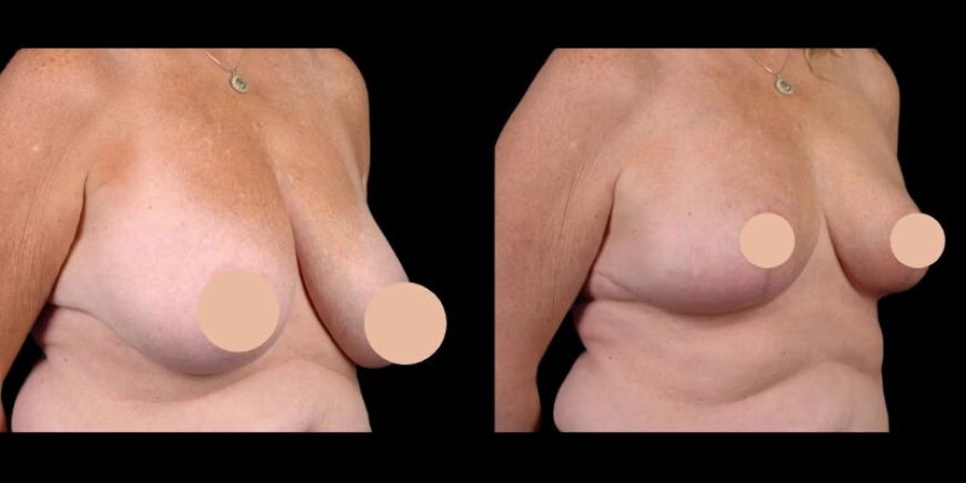 Top Secrets from the Best Doctors in Dubai for Successful Breast Reduction in Dubai