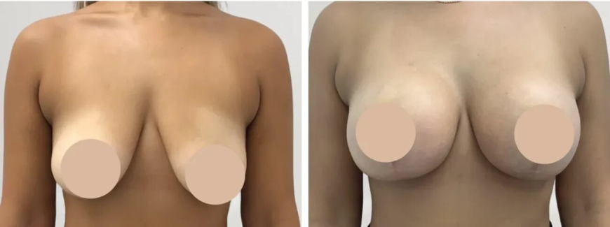 Breast Lift in Dubai Perfection and Precision by the Best Doctors in Dubai