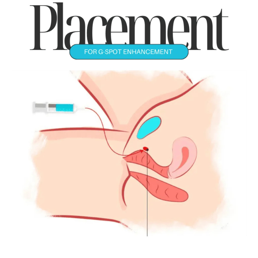 G-Spot Enhancement in Dubai: Cost, Procedure, and Recovery Explained