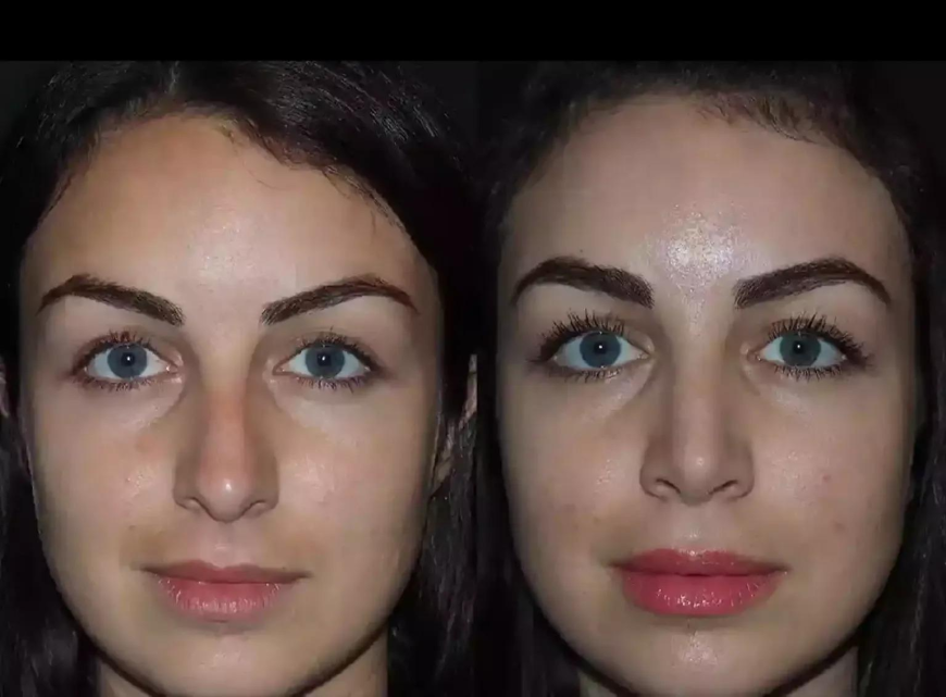 Best Septoplasty Surgeon in Dubai for Functional Nasal Recovery