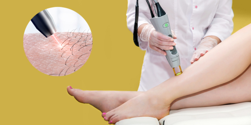 Comprehensive Analysis of the Global Laser Hair Removal Market: Size, Trends, and Strategic Insights