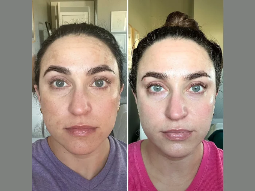 Expert Skin Tightening Treatment at the Best Aesthetic Clinics in Dubai