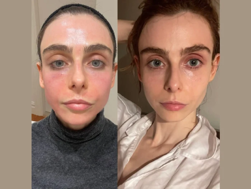 Reverse Aging Signs with Radiofrequency (RF) Microneedling by the Best Plastic Surgeons in dubai