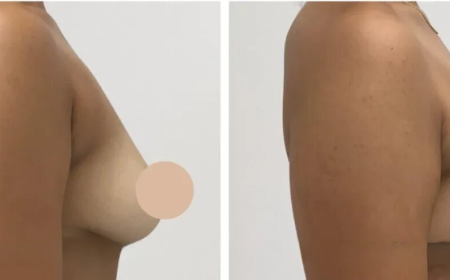The Journey of Transformation through a Breast Lift in Dubai