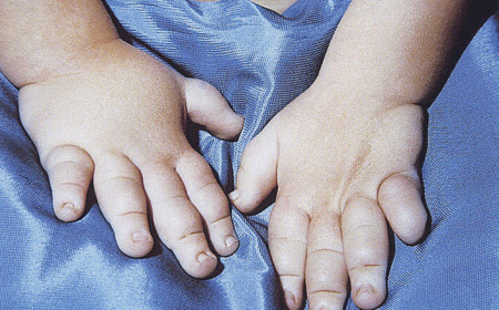 Turner Syndrome Market Size, Trends, and Growth Strategies Analysis