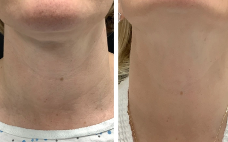 Smooth Skin Reimagined with Radiofrequency (RF) Microneedling by the Best Plastic Surgeons in dubai