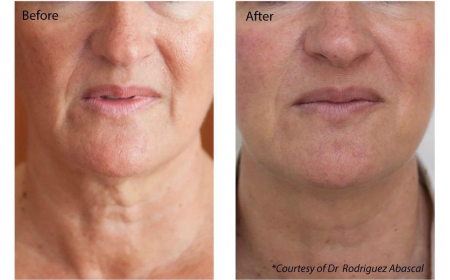 Profhilo at The Medispa: Advanced Skin Booster for Natural, Youthful Radiance