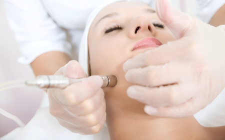 Microdermabrasion in Islamabad: Beauty Glow Boost
