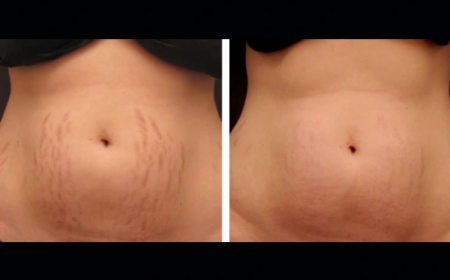 Improve Skin Health with Radiofrequency (RF) Microneedling Treatments in Dubai