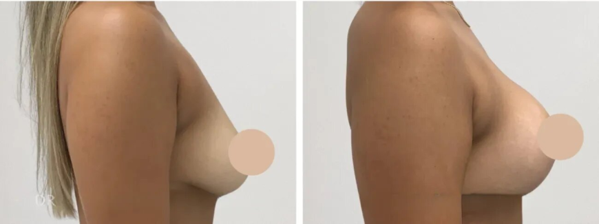 The Journey of Transformation through a Breast Lift in Dubai
