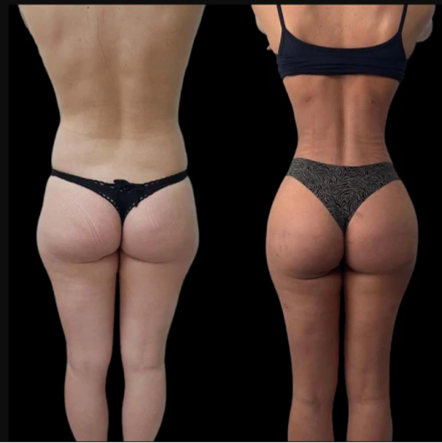 J-Plasma Skin Tightening Results You Can Trust at the Best Aesthetic Clinic in Dubai