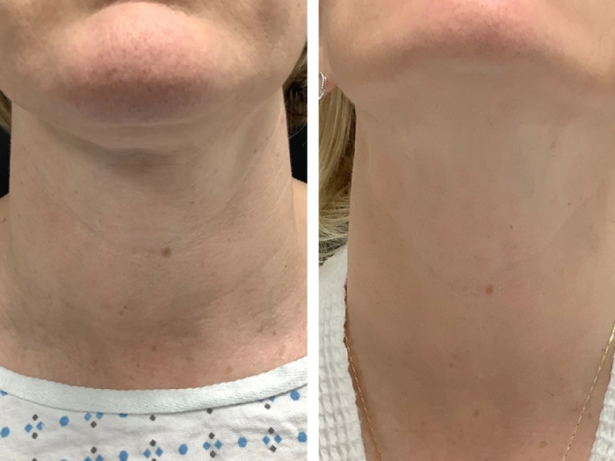 Smooth Skin Reimagined with Radiofrequency (RF) Microneedling by the Best Plastic Surgeons in dubai