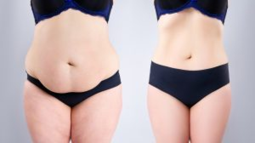 Discover Confidence Again with Tummy Tuck in Dubai
