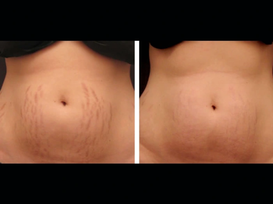 Improve Skin Health with Radiofrequency (RF) Microneedling Treatments in Dubai