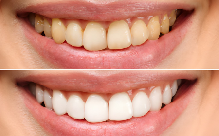 Teeth Whitening Options Explained: Expert Advice from a Huntingburg, IN Dentist
