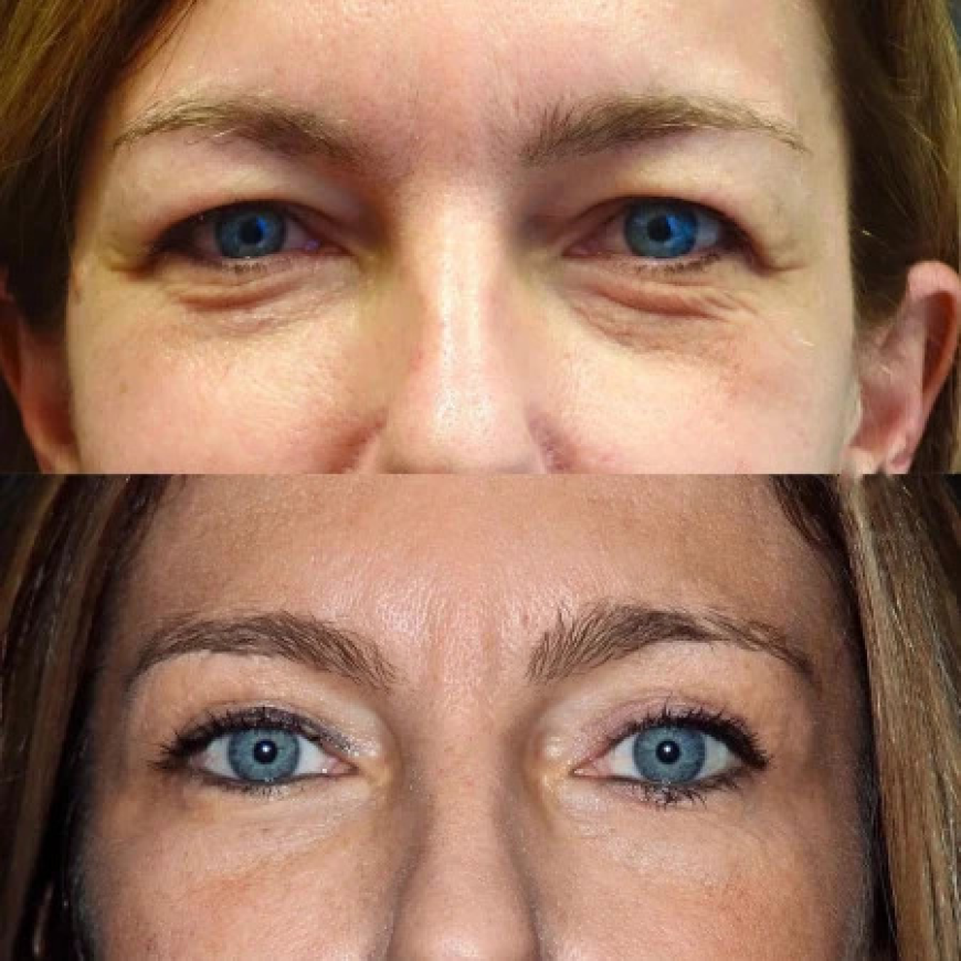 Upper vs Lower Blepharoplasty in Dubai: Which Is Right for You?