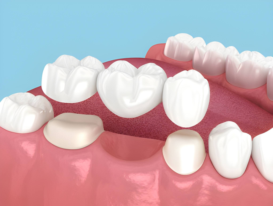 Dental Bridges Explained: A San Antonio Dentist Breaks Down Your Treatment Options