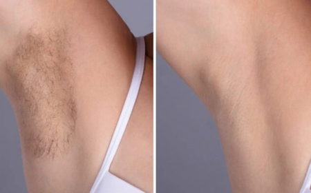 Best Doctors in dubai for Underarm Laser Hair Removal