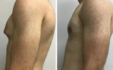 Gynecomastia Surgery in Dubai with Comprehensive Care