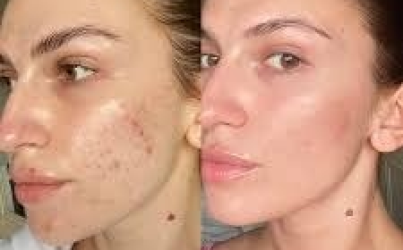 Long-Term Skin Maintenance After Skinpen Microneedling in Altrincham