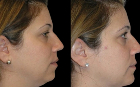 Best Double chin removal Surgeons in dubai Plus