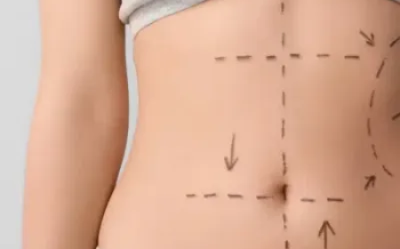 Liposuction in Islamabad – Sculpt Your Body with Expert Fat Removal