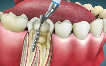 Say Goodbye to Tooth Pain – Root Canal Islamabad