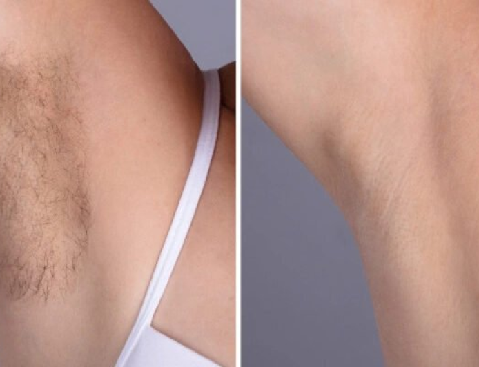 Best Doctors in dubai for Underarm Laser Hair Removal