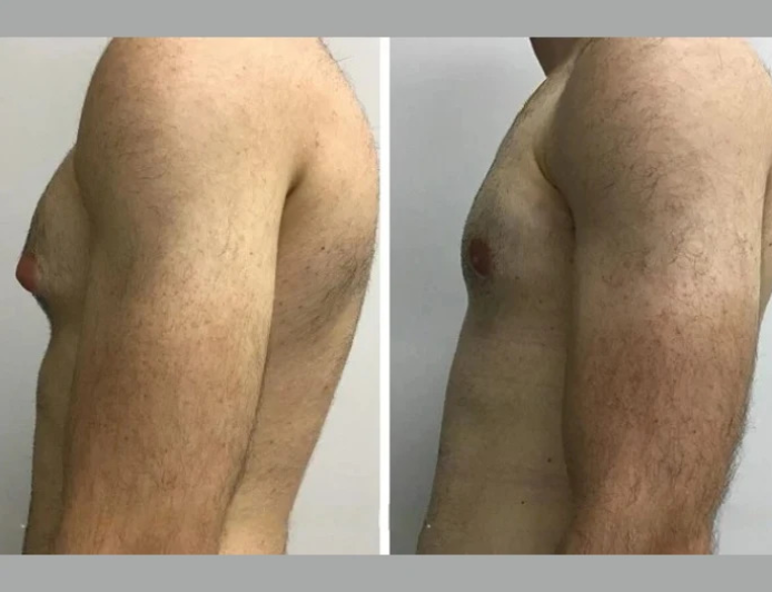Best Gynecomastia Surgeons in Dubai Ensuring Quality Care