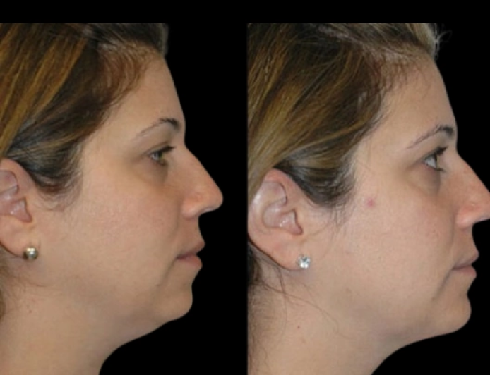 Double Chin Removal for Enhanced Side Profile by the Best Doctors in Dubai
