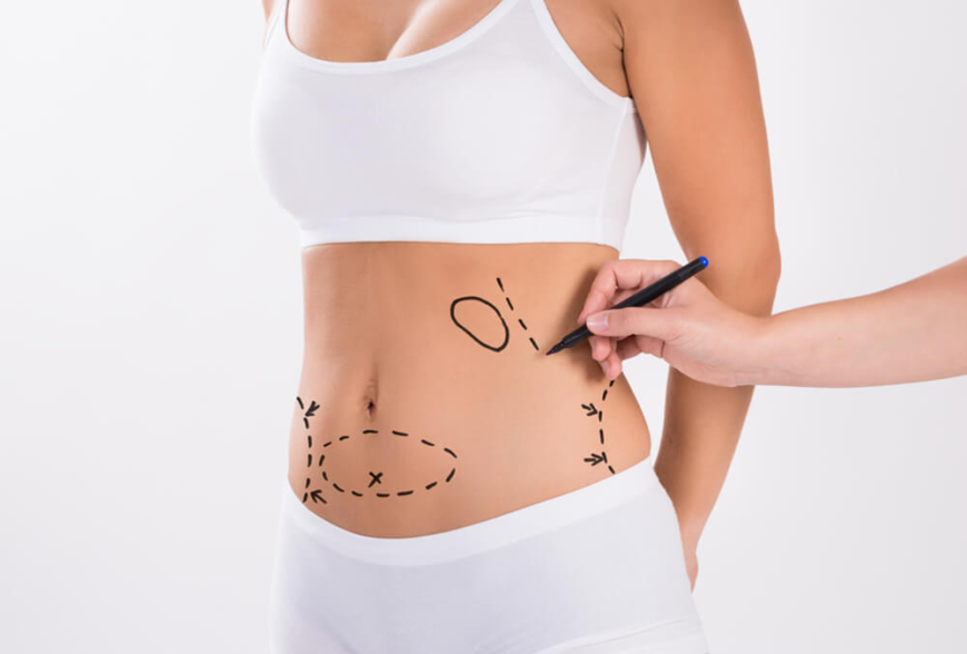 Best Liposuction Surgeon in Dubai Known for Patient Satisfaction