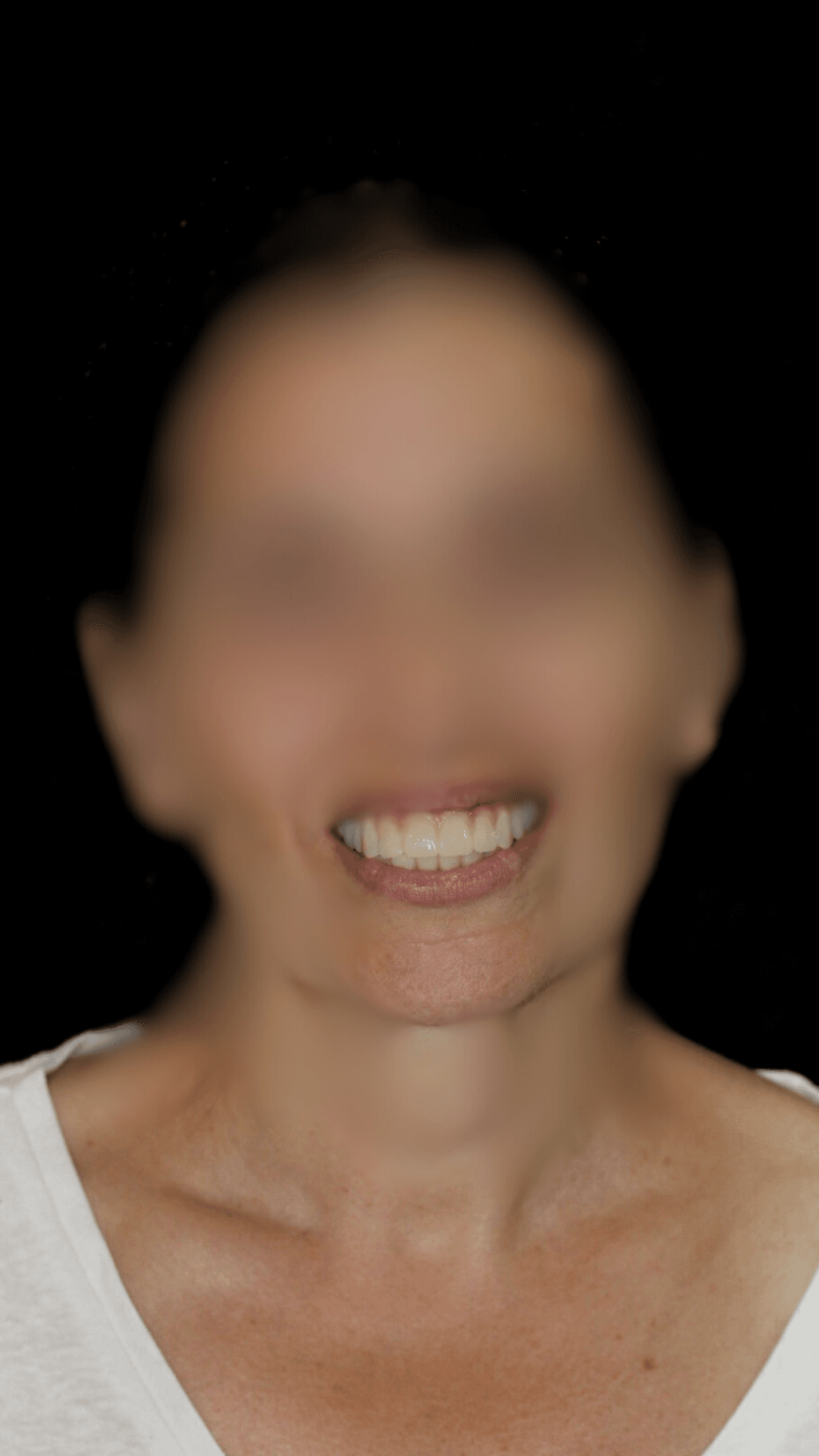 Implantes de Carga Inmediata en Barcelona Sonrisa Nueva en un Día