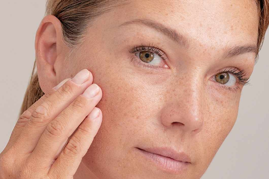 Melasma treatment in Islamabad That Works