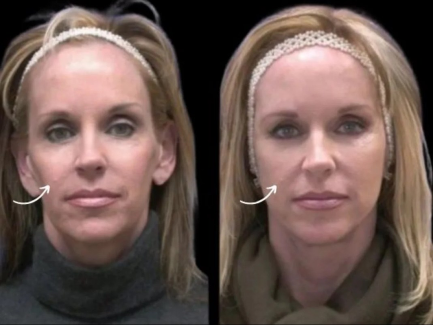 Sculptra Treatments in Dubai for Advanced Facial Architecture