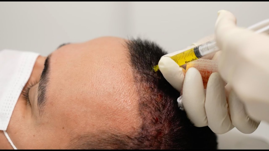 The Growing Demand for PRP Hair Treatment in Modern Clinics