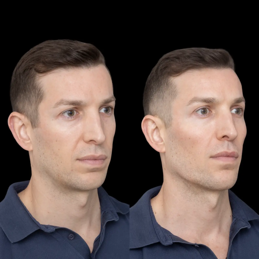 Jawline Fillers Before and After – Best Plastic Surgeon in dubai