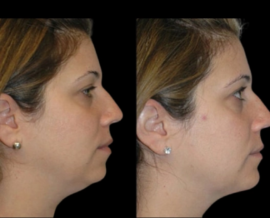 Best Double chin removal Surgeons in dubai Plus